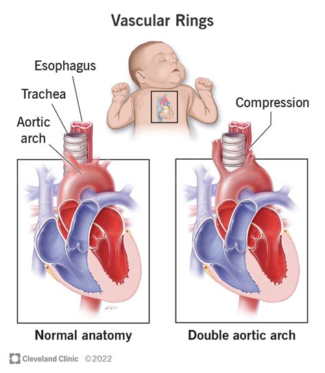 Vascular Rings: Causes and Symptoms