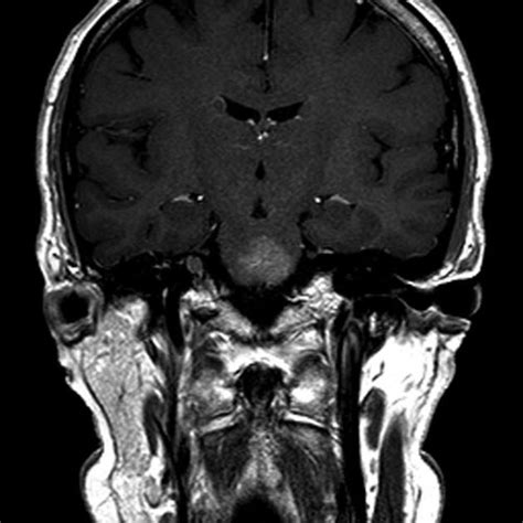 Capillary telangiectasia | Radiology Case | Radiopaedia.org Central Nervous System, Radiology ...