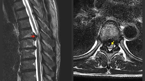 Herniated Disc Thoracic Mri