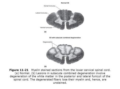 Subacute Combined Degeneration - Stepwards