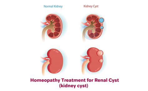 17 Best Kidney Cysts Home Remedies : Homenaturalcures