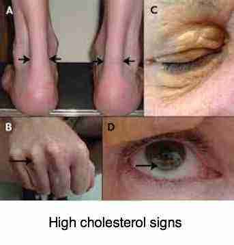 High cholesterol symptoms are astonishingly few and far between.