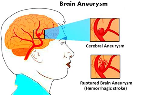 Symptoms of Brain Aneurysm: How to find Aneurysm in early days