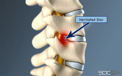 Common Herniated Disc Procedures | Spine & Orthopedic Center