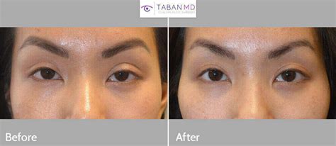 Revisional Eyelid Ptosis Surgery Before and After Gallery | Taban MD