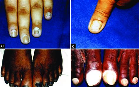 (a) Distal and lateral subungual onychomycosis. (b) Total dystrophic... | Download Scientific ...