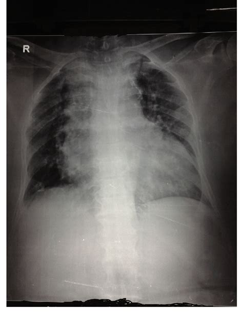 Chest X-ray showing cardiomegaly. | Download Scientific Diagram