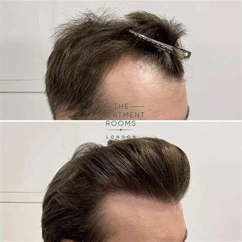 Receding Hairline & Hairline Transplant | Treatment Rooms London