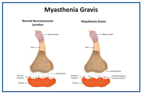 Myasthenia Gravis: Causes, Symptoms & Treatment Options