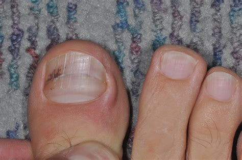Melanoma toenail images - Awesome Nail