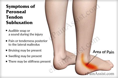 Peroneal Tendon Subluxation: Treatment, Recovery, Exercises, Symptoms ...