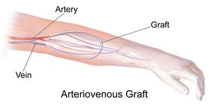 What are Dialysis and Fistula/Graft Declotting and Interventions? - The ...