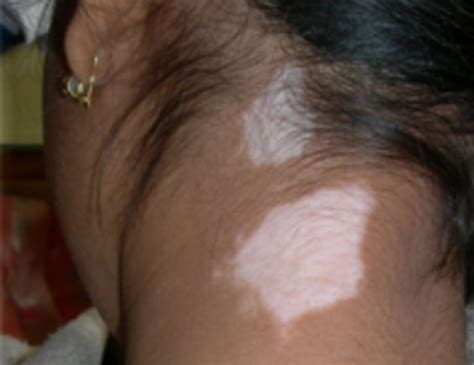 Como Quitar Manchas Blancas En La Piel Naturalmente - Vitiligo Tratamiento: Cura El Vitiligo En ...