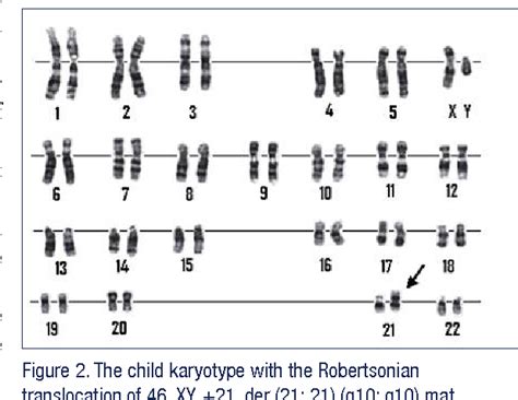 Translocation Down Syndrome Karyotype