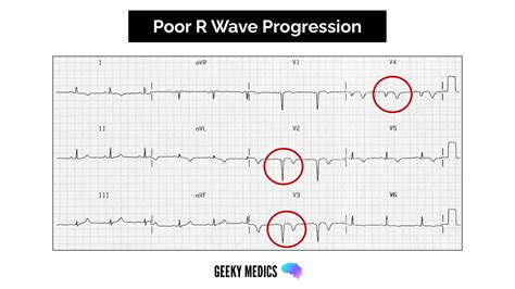 High s waves ecg causes - perkslimfa