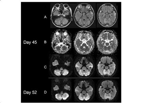 Brain MRIs obtained during the acute stage of cerebellar stroke-like ...