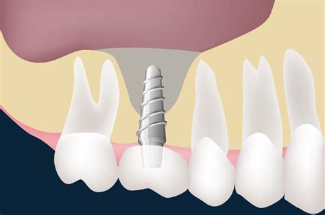 Sinus Lift | DMS Dentistry