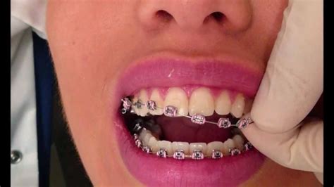 Bailey Orthodontics: Life After Braces: Retention