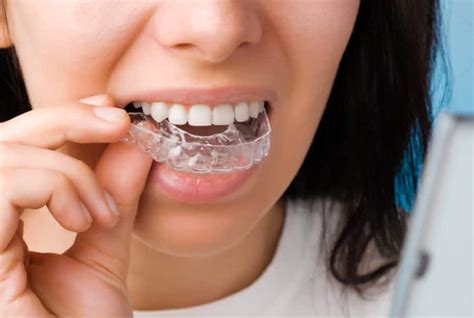 How Does a Retainer Work? | Colgate® IN