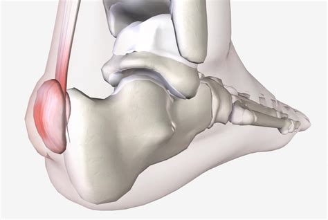 Pea Sized Lump On Achilles Tendon - Bump On Bottom Of Foot 9 Causes And How To Get Rid Of It ...