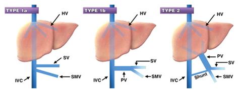 Clinical and Radiologic Manifestations of Congenital Extrahepatic Portosystemic Shunts: A ...