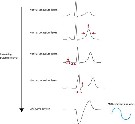 ECG changes due to electrolyte imbalance (disorder) – ECG learning