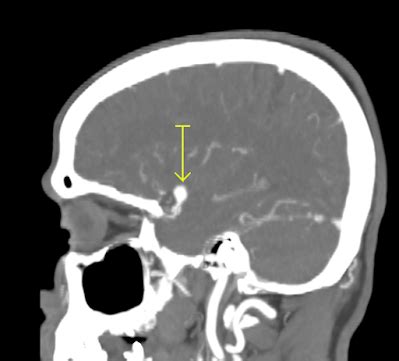 ct brain aneurysm - CT Scan & MRI