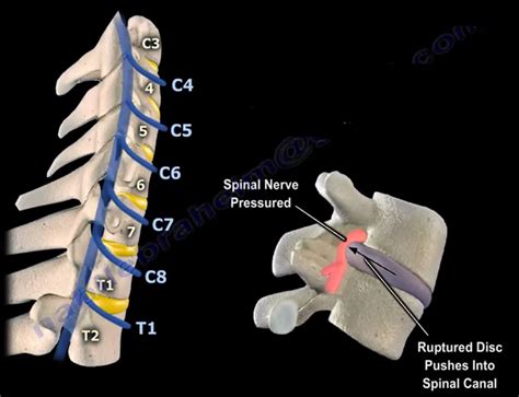 Neck Pain, Cervical Disc Herniation, & Cervical Radiculopathy | by Nabil Ebraheim | Medium