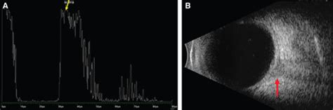 T Sign In Posterior Scleritis - Ps with serous retinal detachment ...