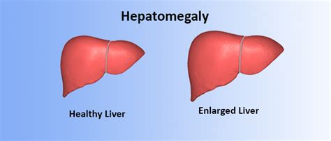 Hepatomegaly (Enlarged Liver): Symptoms, Causes, Treatment, And Diagnosis