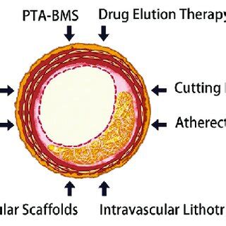 Common therapies for critical limb ischemia | Download Scientific Diagram