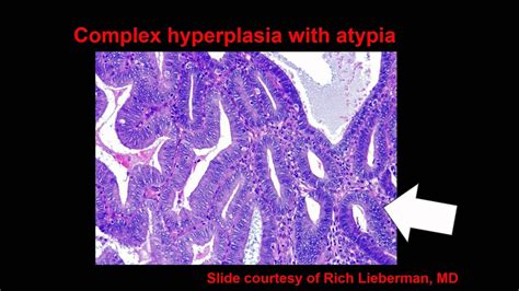 Topic 54: Endometrial Hyperplasia and Carcinoma