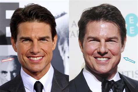 Did Tom Cruise Have Plastic Surgery? (Before & After Photos)