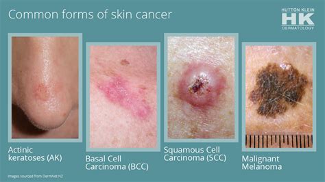 Skin Cancer Types Squamous Cell Carcinoma