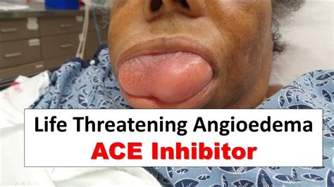 Life Threatening ACE Inhibitor Induced Angioedema - YouTube