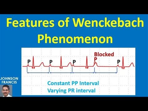 Features of Wenckebach Phenomenon - YouTube