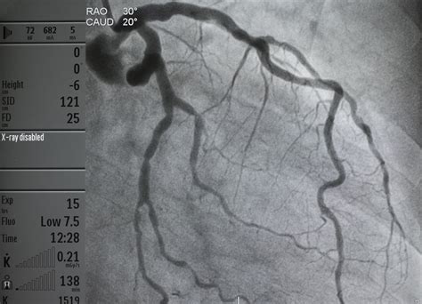 Markers to Predict CI-AKI in Patients With ACS Undergoing Coronary Angiography - Renal and ...