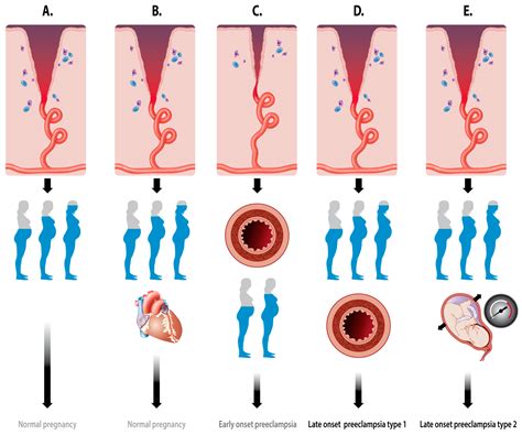 JCM | Free Full-Text | Preeclampsia Is a Syndrome with a Cascade of ...