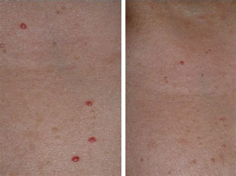 View 12 Cherry Angioma Laser Removal Before And After - townsmenwit