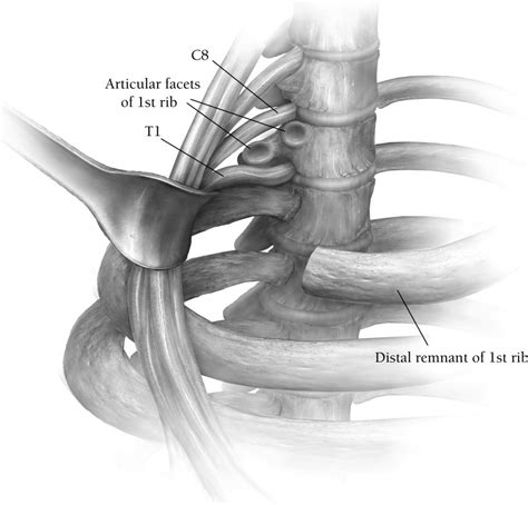 Supraclavicular Approach to First Rib Resection for Thoracic Outlet Syndrome - Operative ...