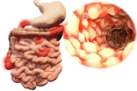 Enteritis: causes, symptoms and treatment – Healthy Food Near Me