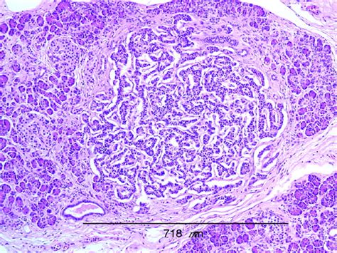 Pancreatic polypeptide cell hyperplasia of the pancreas | Journal of ...