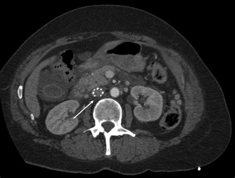 Fracture and Embolization of an Inferior Vena Cava Filter Strut Leading to Cardiac Tamponade ...