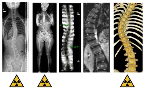 Lumbar Scoliosis X Ray