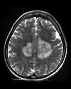 Cmv Retinitis Mri