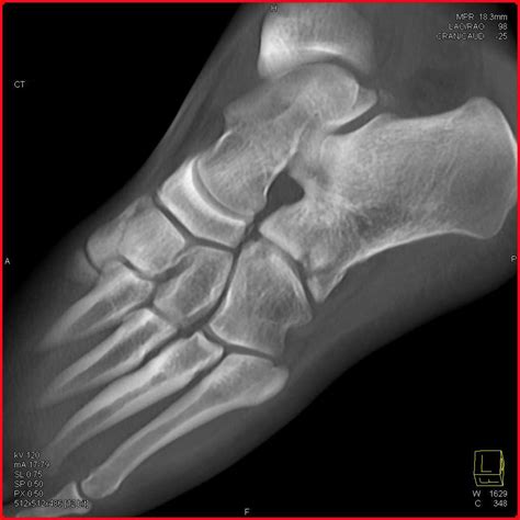 Calcaneal and Cuboid Fractures - Musculoskeletal Case Studies - CTisus ...