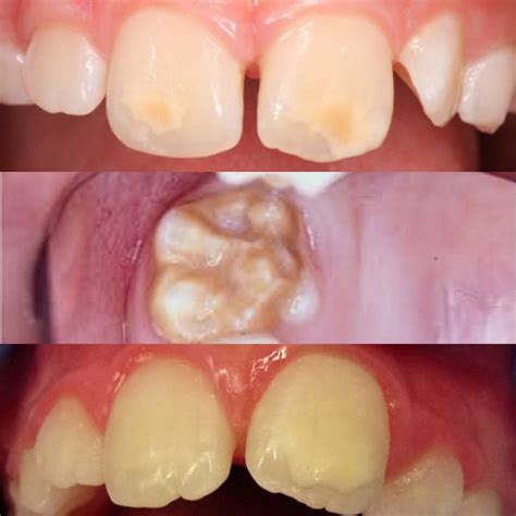 What's this spot on my tooth? - Enamel Hypoplasia or Hypomineralization - Bite Size Pediatric ...