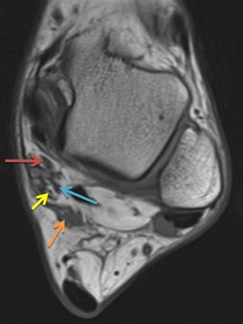 Tarsal Tunnel Syndrome Mri