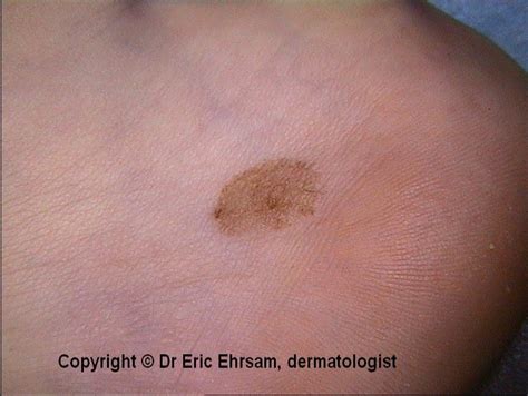 dermoscopy: Acral melanocytic nevus with a globular pattern