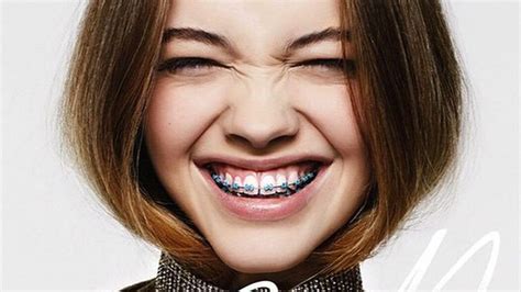 Are braces really a new fashion trend? – Metro US